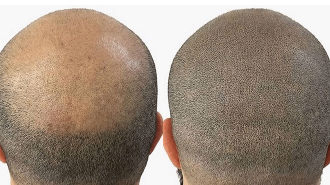 Hair pigmentation Treatment in London | Micropigmentation Uk