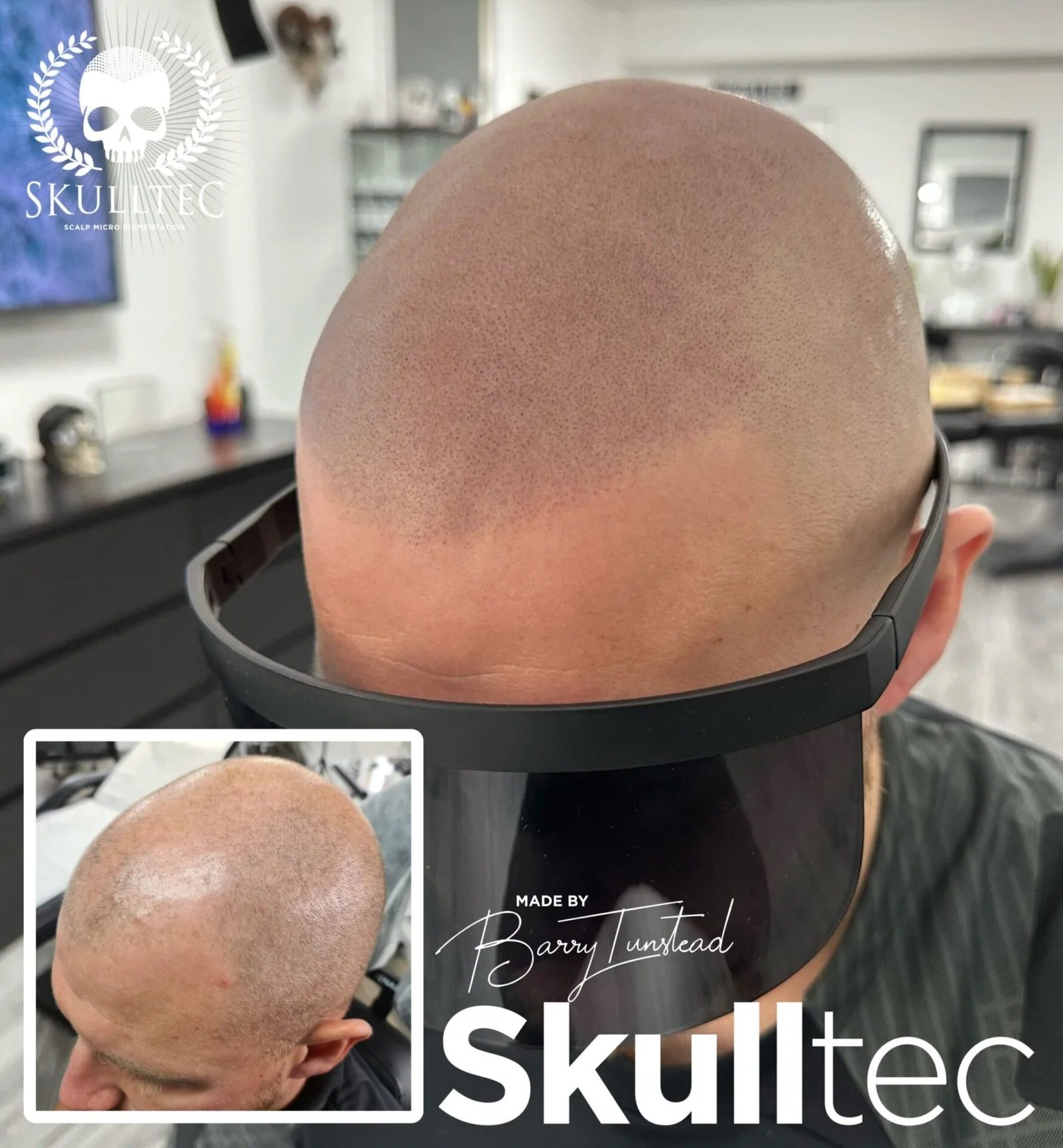 Scalp Micropigmentation in London : Meet Barry Tunstead