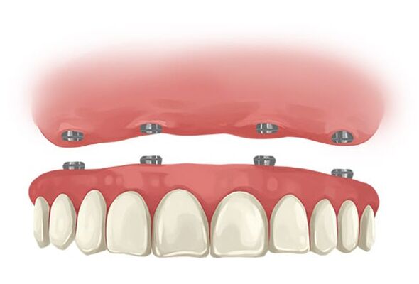 Pterygoid Dental Implants: Expanding Possibilities for Missing Teeth – BDnews55.com