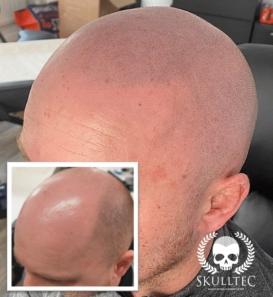 How to Get the Best Scalp Micropigmentation Results