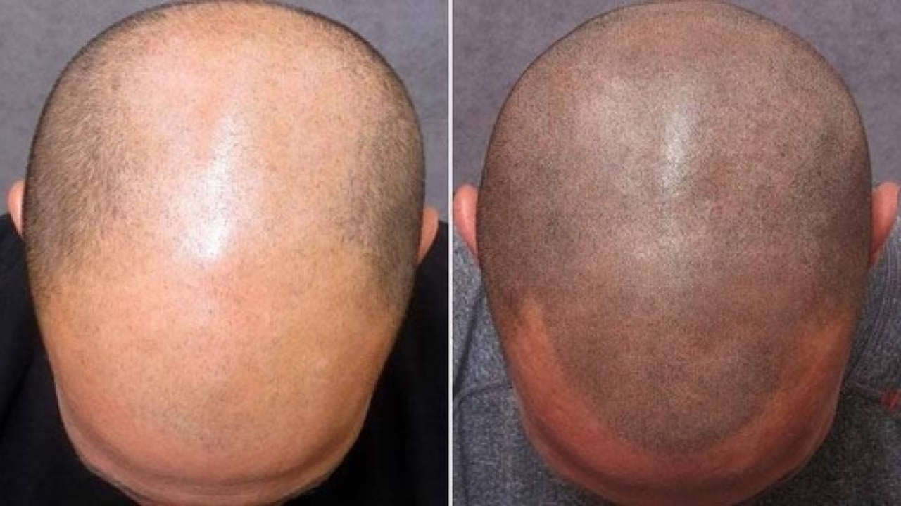 Differences Between Hair Tattoo vs Body Tattoo (maintenance)