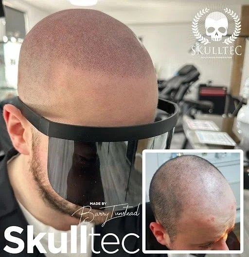 Recovery After Scalp Micropigmentation in London | Healing Timeline & Tips