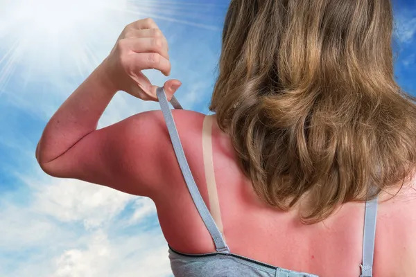 Sunburn vs Sun Poisoning: When to See a Doctor