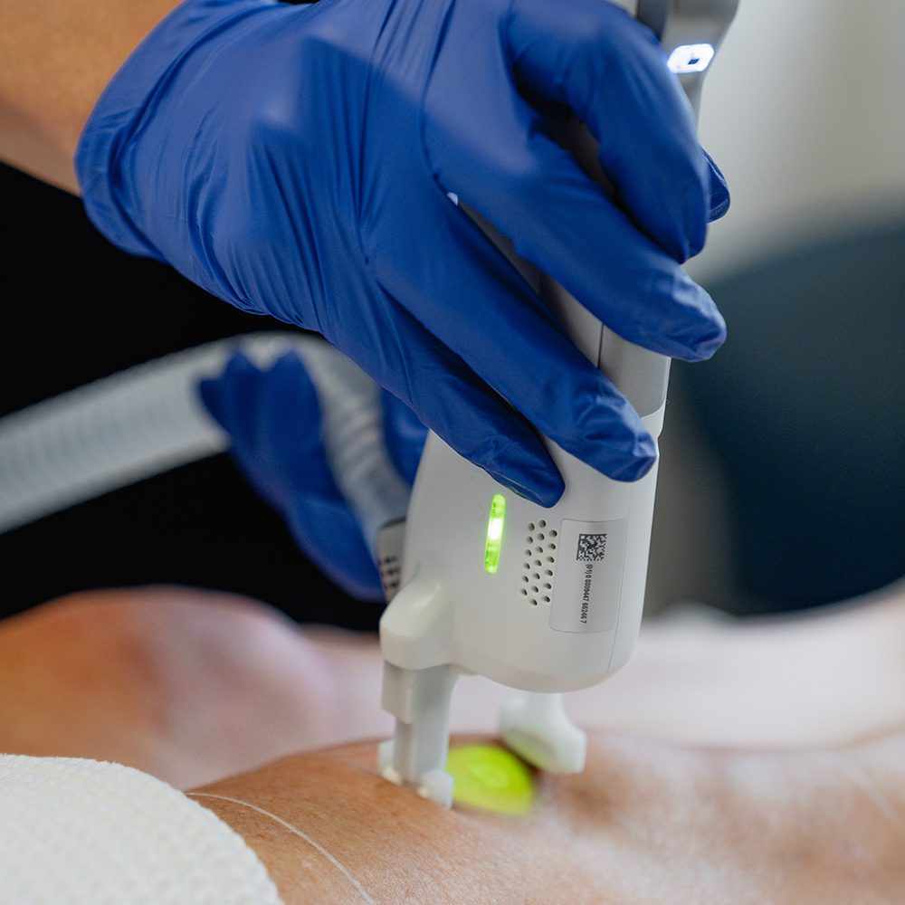 What Is Laser Hair Removal Kalispell & How Does It Work?