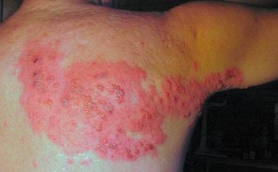 Homeopathy for Herpes Zoster – Effective& Safe Treatment
