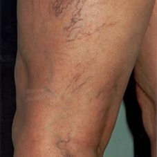 Best Leg Vein Treatment Methods: Which Vein Therapy Is Right for You? – @agelesslasercentres on Tumblr