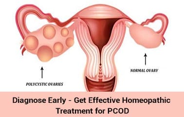 Find the Best Homeopathic Doctor for PCOD Treatment