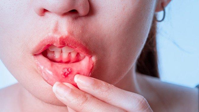 Coated Tongue Vs. A Real Oral Thrush Diagnosis Check | Articles | Advanced Dermatology Skin Cancer Specialists | Gan Jing World - Technology for Humanity | Video & Movie Streaming