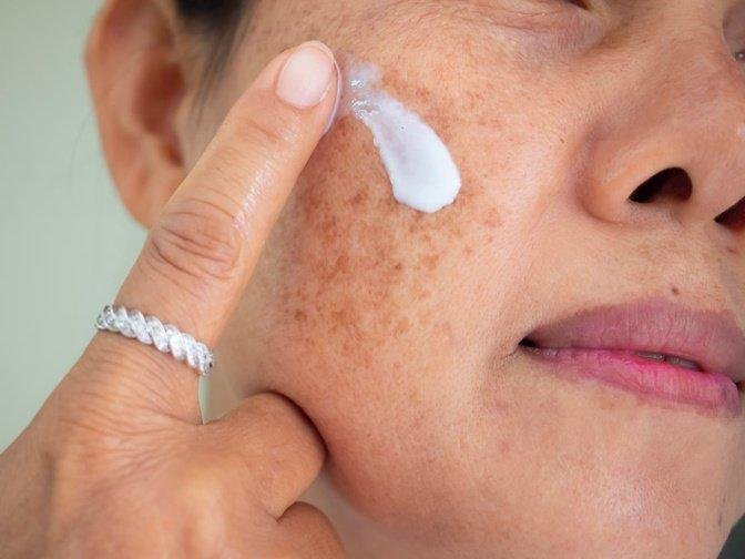 How to Choose Melasma Treatment in Mississauga | Articles | Kevinnn | Gan Jing World - Technology for Humanity | Video & Movie Streaming
