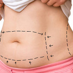 Liposuction in Riyadh